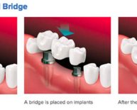 Dental Implants California