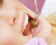Dental Implants explained
