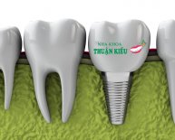 Dental Implants Options