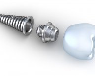 Dental Implants parts