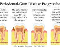 Dental Implants Periodontal Disease