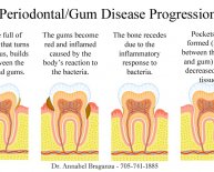 Dental Implants Periodontal Disease