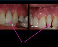 Dental Implants Problems