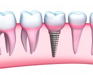 Dental Implants Procedure