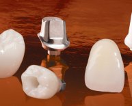 Dental Implants Procedure video