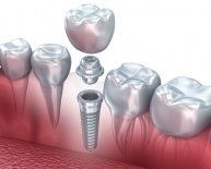 Dental Implants Procedures