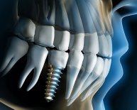 Dentistry that do Dental Implants