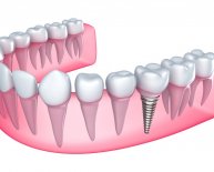 Kinds of Dental Implants