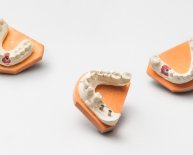 Questions about Dental Implants