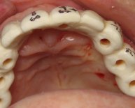 Surgical stent for Dental Implants
