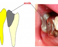 Titanium in Dental Implants