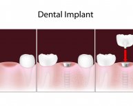 Tooth Implants covered by insurance