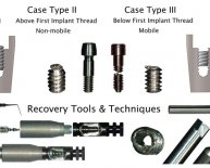 Types of Dental Implant Abutments