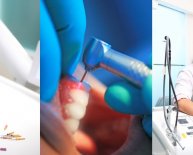 Types of implants in Dentistry