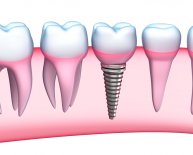 What are Dental implants?