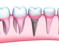 What are the risks of Dental implants?