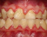 What is oral hygiene Definition?