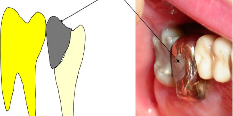 Titanium in Dental Implants