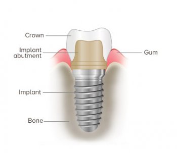 Toothpick implant image