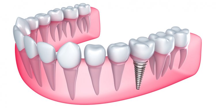 Types of tooth Replacement