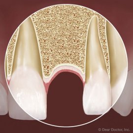 You Have Options for Replacing a Lost Tooth