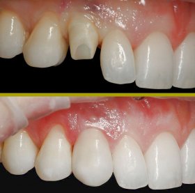 Zirconium Dental Implant anterior case.